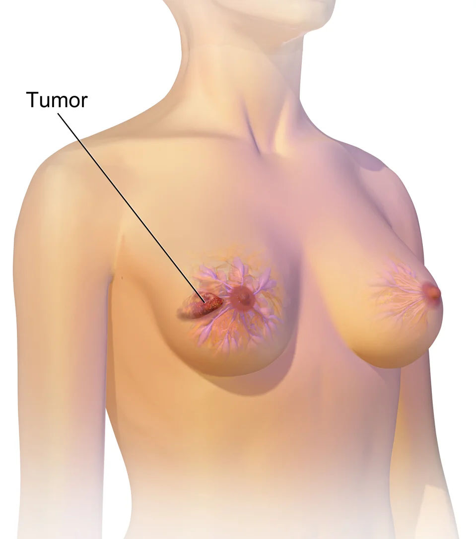 Breast Cancer Awareness: Early Detection, Care and Recovery